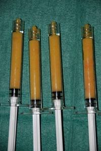 fat-injection-lipostructure-labial-augmentation ЛАБИОПЛАСТИКА ПО УВЕЛИЧЕНИЮ ПОЛОВЫХ ГУБ