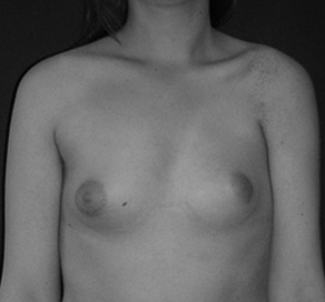 poland syndrome ХИРУРГИЯ ПОРОКОВ РАЗВИТИЯ ГРУДИ