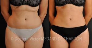 liposuccion-ventre-poignees-amour ЛИПОСАКЦИЯ — ЛИПОАСПИРАЦИЯ